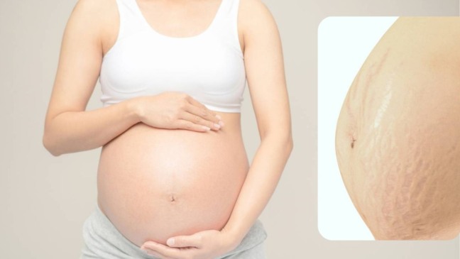 Estes cuidados com a pele reduzem o risco de estrias na gravidez