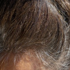 Para quem deseja amenizar a aparência das canas, há soluções seguras e acessíveis - Créditos: depositphotos.com / Vejaa