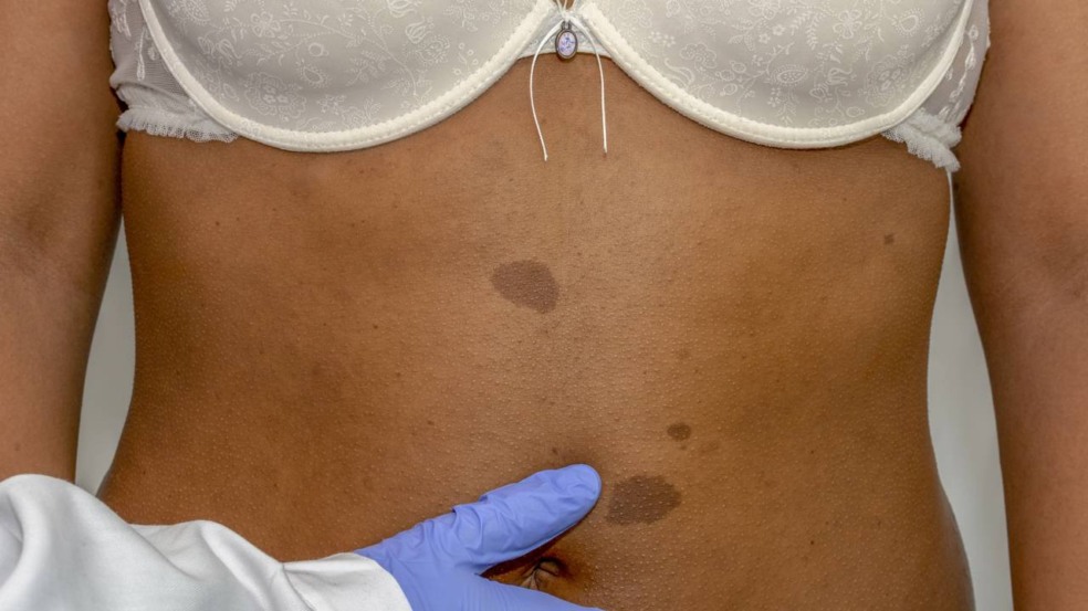 O surgimento de manchas corporais geralmente está ligado ao aumento ou diminuição da produção de melanina - Créditos: depositphotos.com / Dolores_Giraldez