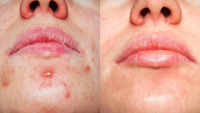 O cuidado com a pele sensível e avermelhada começa em pequenos hábitos diários - Créditos: depositphotos.com / Alina_ptashka