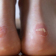 Alguns cuidados simples ajudam a reduzir bastante o surgimento de bolhas nos pés - Créditos: depositphotos.com / malcevang@gmail.com