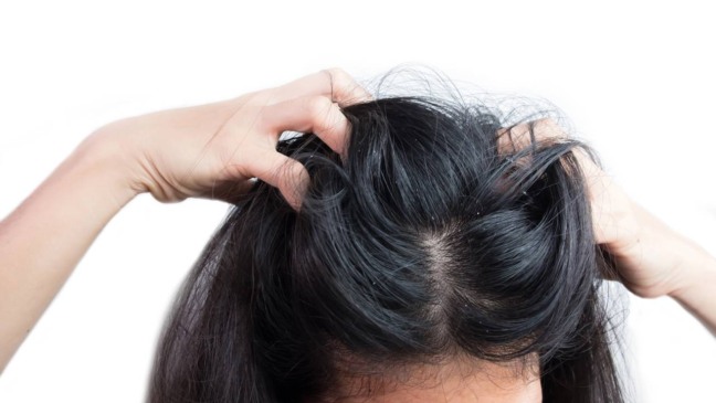 Um ponto que costuma gerar dúvidas é se a caspa passa de uma pessoa para outra - Créditos: depositphotos.com / sirinatestocker.gmail.com