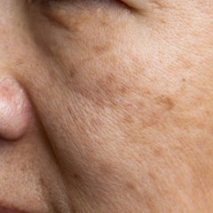 Além dos tratamentos convencionais, quem convive com o melasma pode recorrer a métodos naturais - Créditos: depositphotos.com / toa55